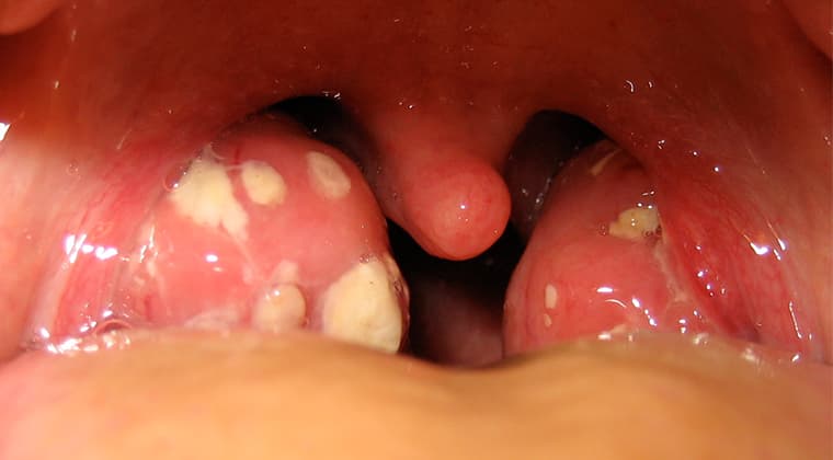 Amigdalitis / Faringoamigdalitis