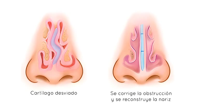 Desviación del Tabique Nasal