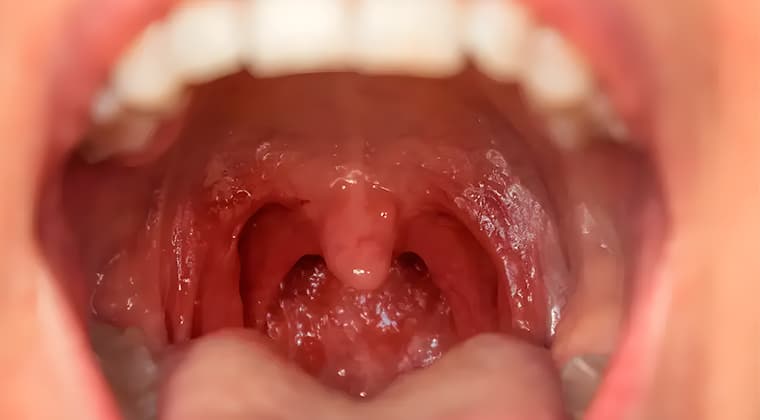Faringitis crónica