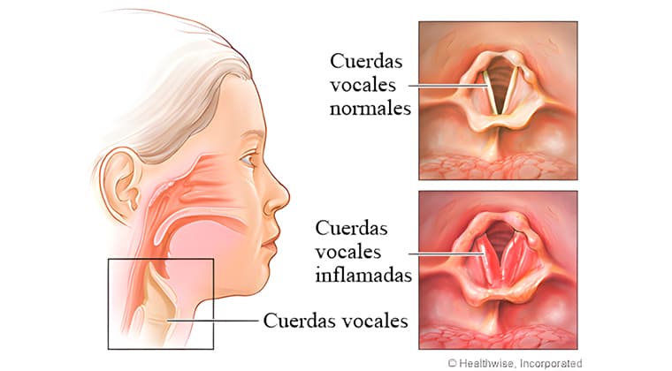 Fondo de Laringitis