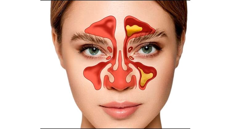 Sinusitis (aguda o crónica)