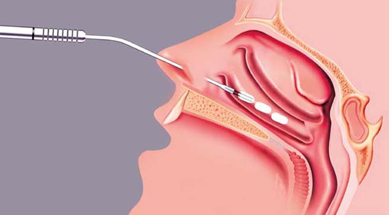 Consulta médica - cirugia-de-cornetes-nasales